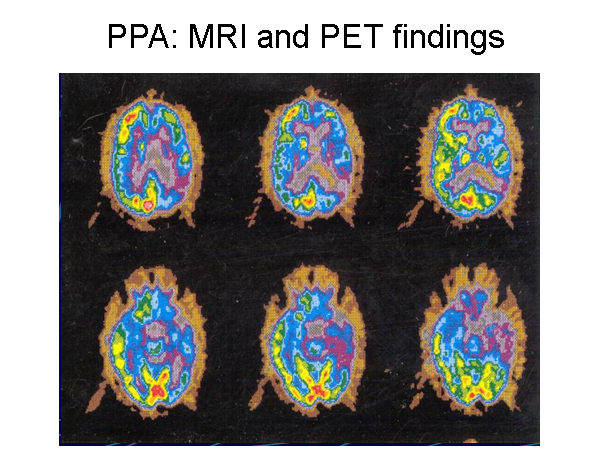 Patient with progressive nonfluent aphasia. Posit...