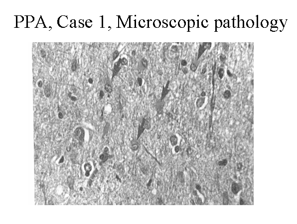 Hematoxylin and eosin stain of the left frontal c...